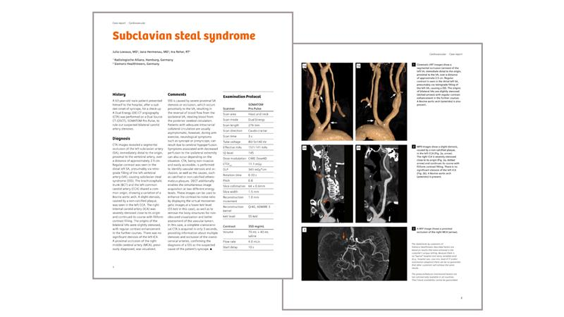 Clinical case preview: Diagnosis of subclavian steal syndrome after sudden onset of syncope