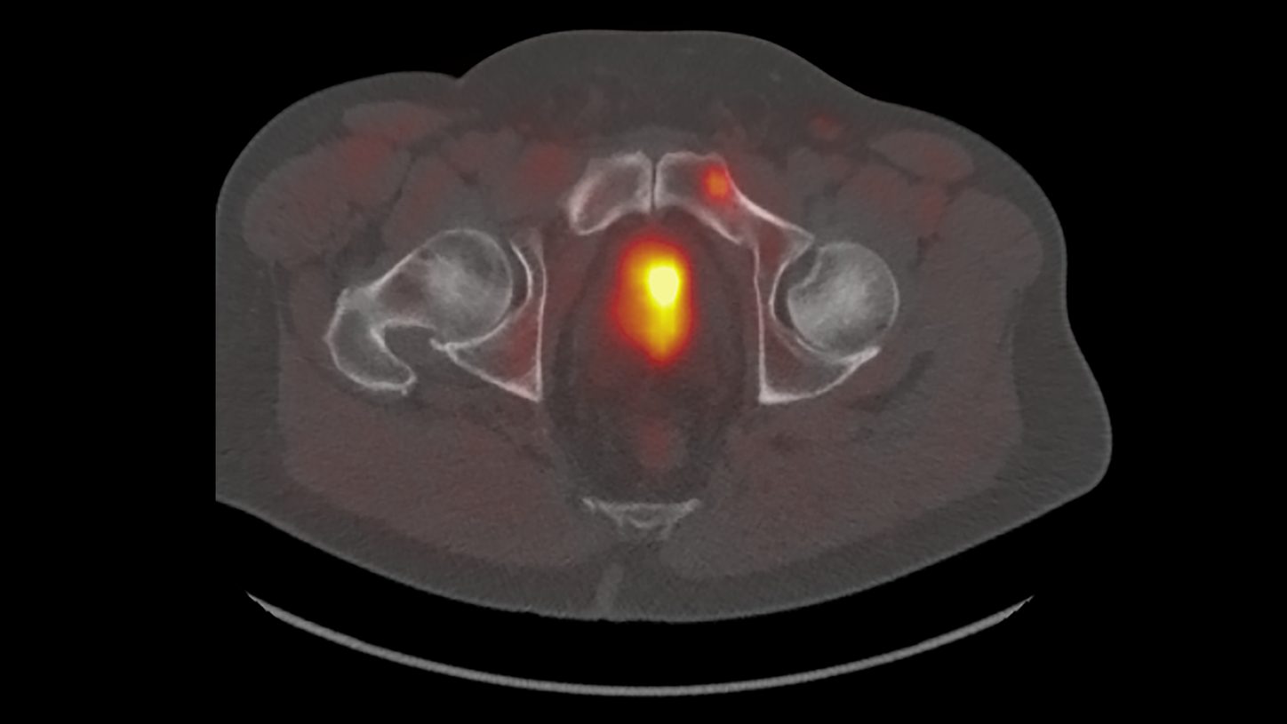 Molecular Imaging - PET/CT and the changing prostate panorama in biochemically recurrent prostate cancer