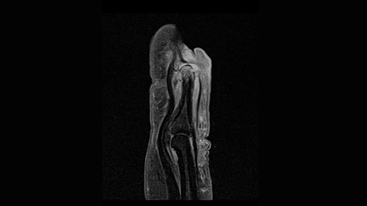 CT image of retro-ocular masses causing exophthalmos along with bilateral perinephric, pericardial, and pelvic exudates