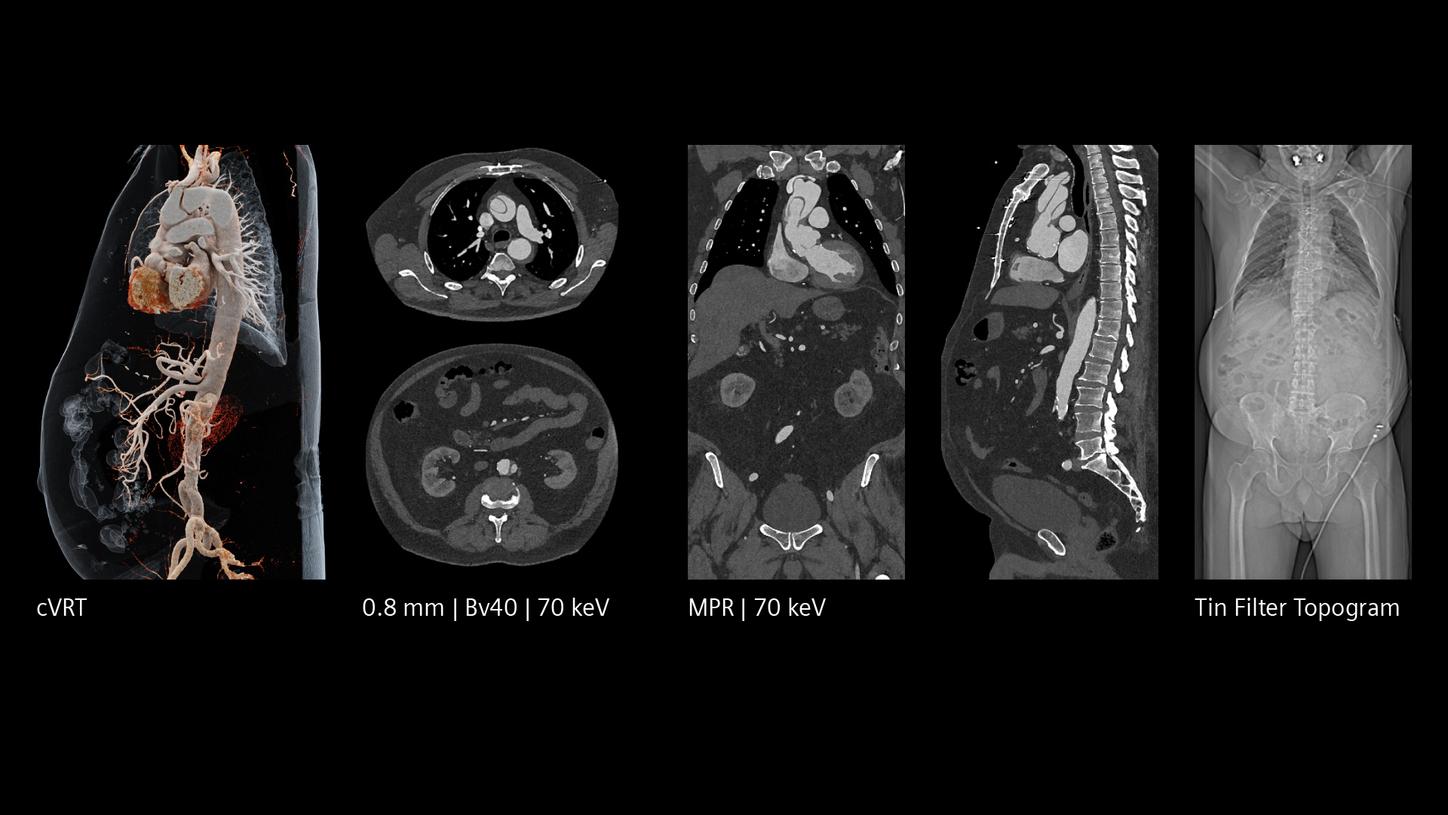Full-body CT showing 3D vascular rendering, cross-sectional images, and topogram with fast scan time and low dose.