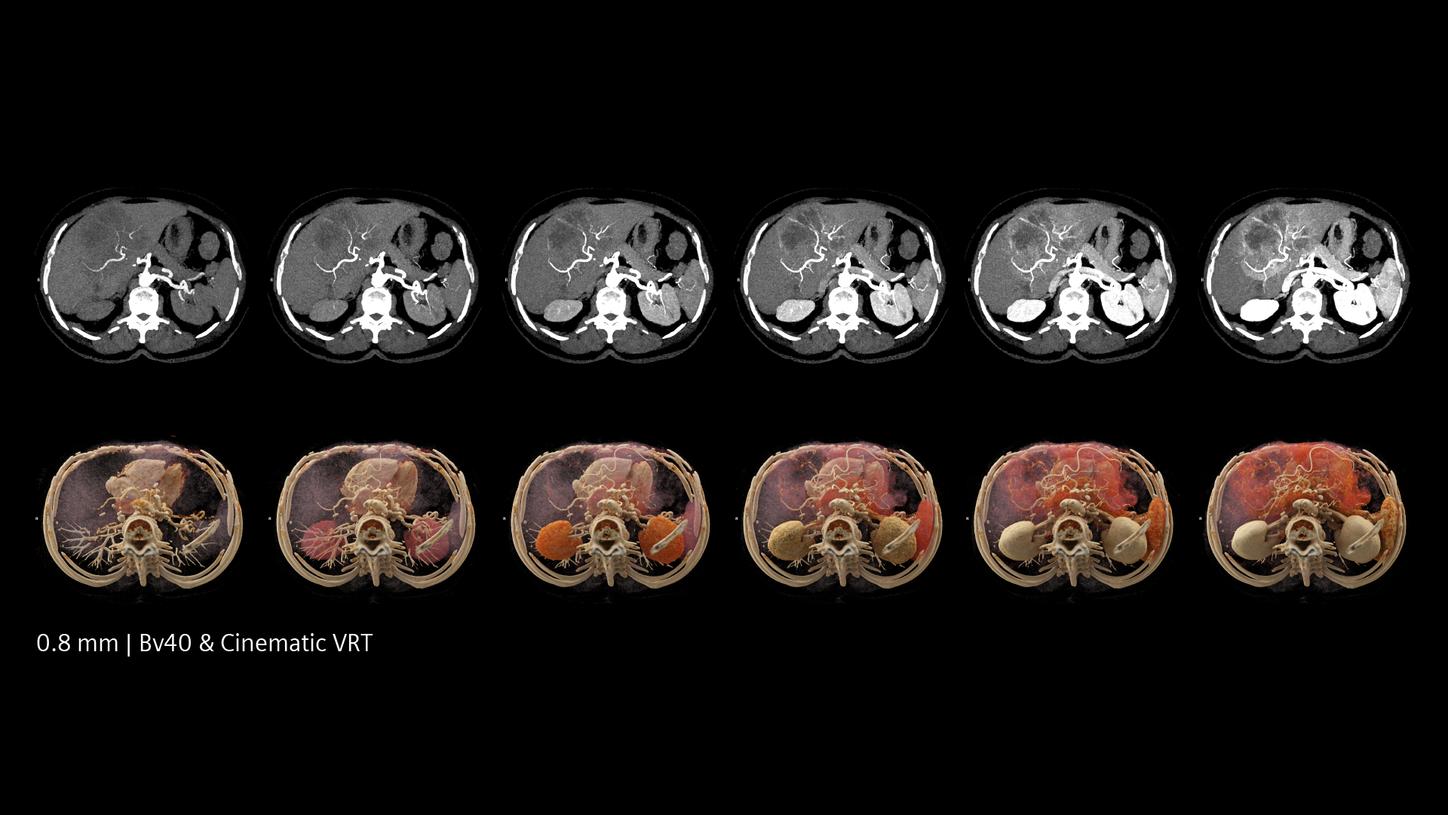 Low dose image of functional liver lesion assessment with high sub-millimeter image quality.