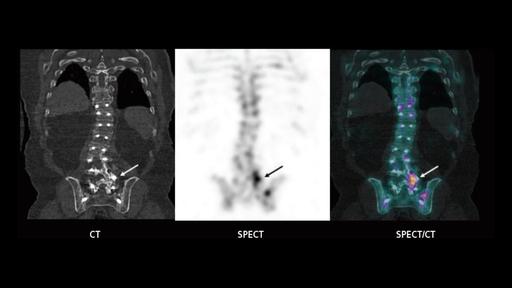 SPECT/CT imaging in the evaluation of pain following spinal fusion ...