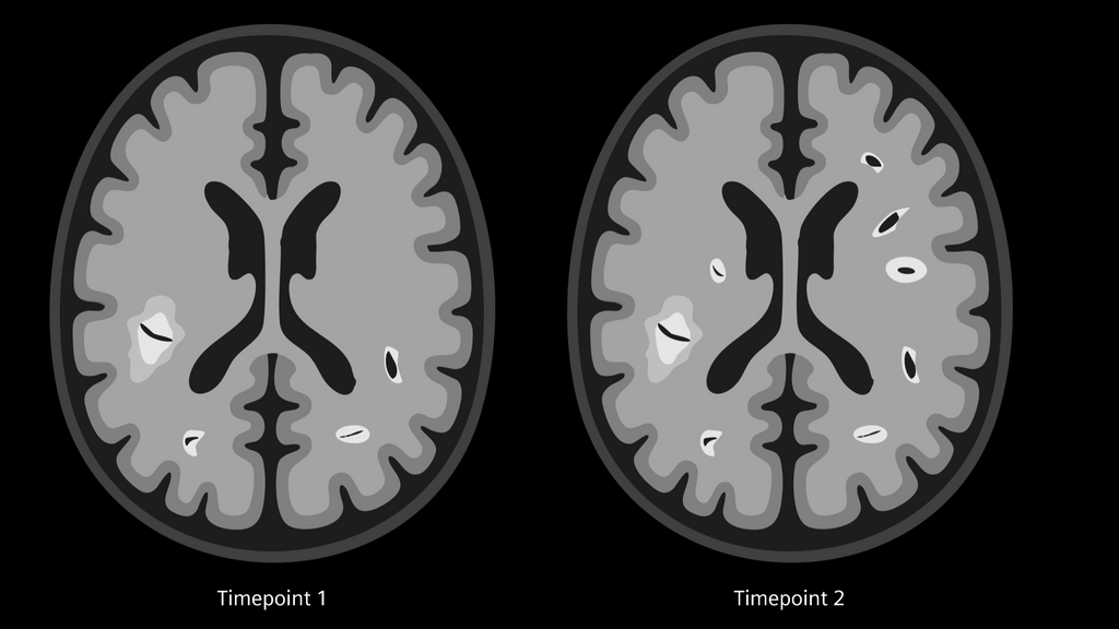 MRI in Multiple Sclerosis - Siemens Healthineers