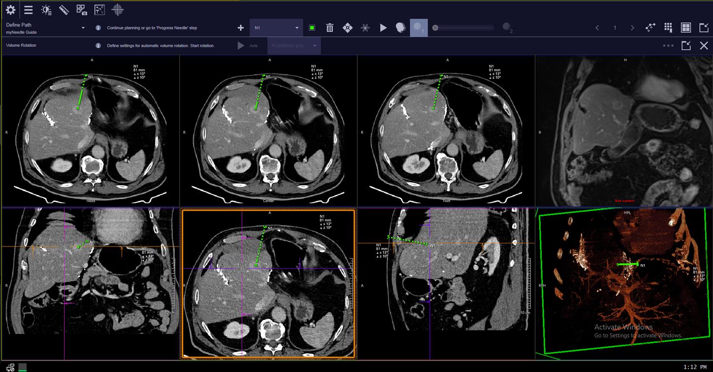 myNeedle Guide 3D with SOMATOM go.All