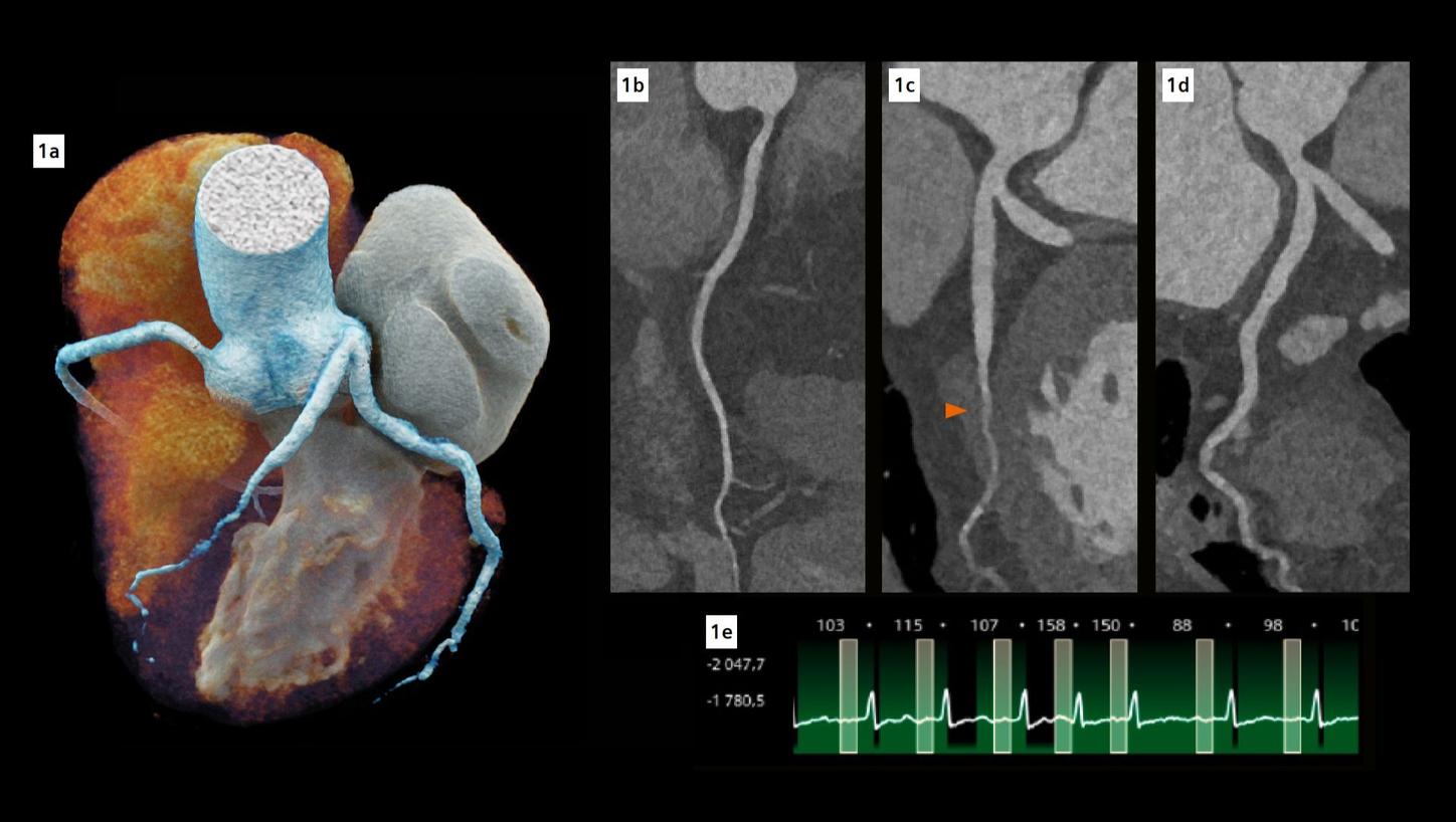 A cVRT image of the heart and curved multiplanar reconstructions of the three coronary arteries, namely the right coronary artery, the left main, and the left anterior descending. A complete myocardial bridge is noted in the mid-segment of the left anterior descending artery. The coronary arteries are clearly visualized despite a high and irregular heart rate ranging from 86 to 158 beats per minute, as documented in the ECG file.