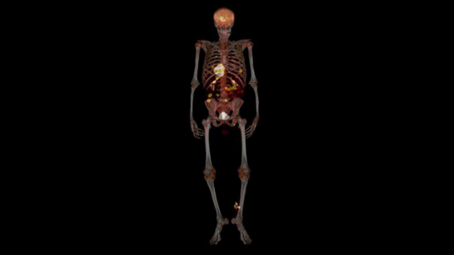 Stages of continuous bed motion on PET/CT scan