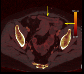Fig 4: Axial PCCT scan (oral and IV contrast) iodine mapping showed a normal mucosal iodine uptake (yellow arrow).