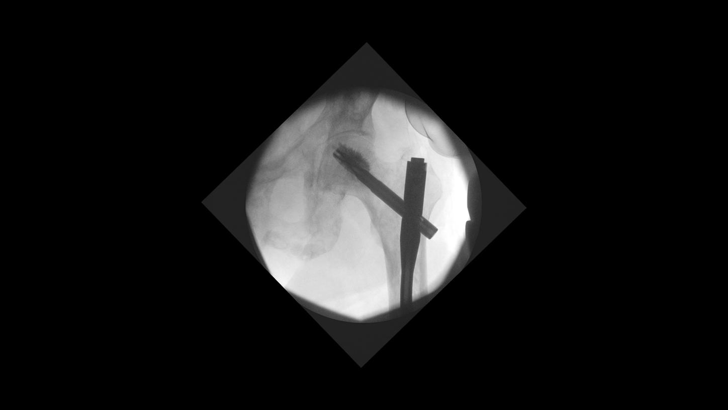 Femur surgery with Cios Select, a 2D C-arm for surgery.