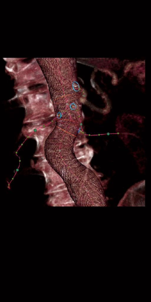 Clinical image showing the aorta and anatomical landmarks automatically segmented and marked in a pre-procedural CTA
