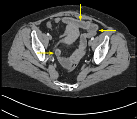 Axial conventional