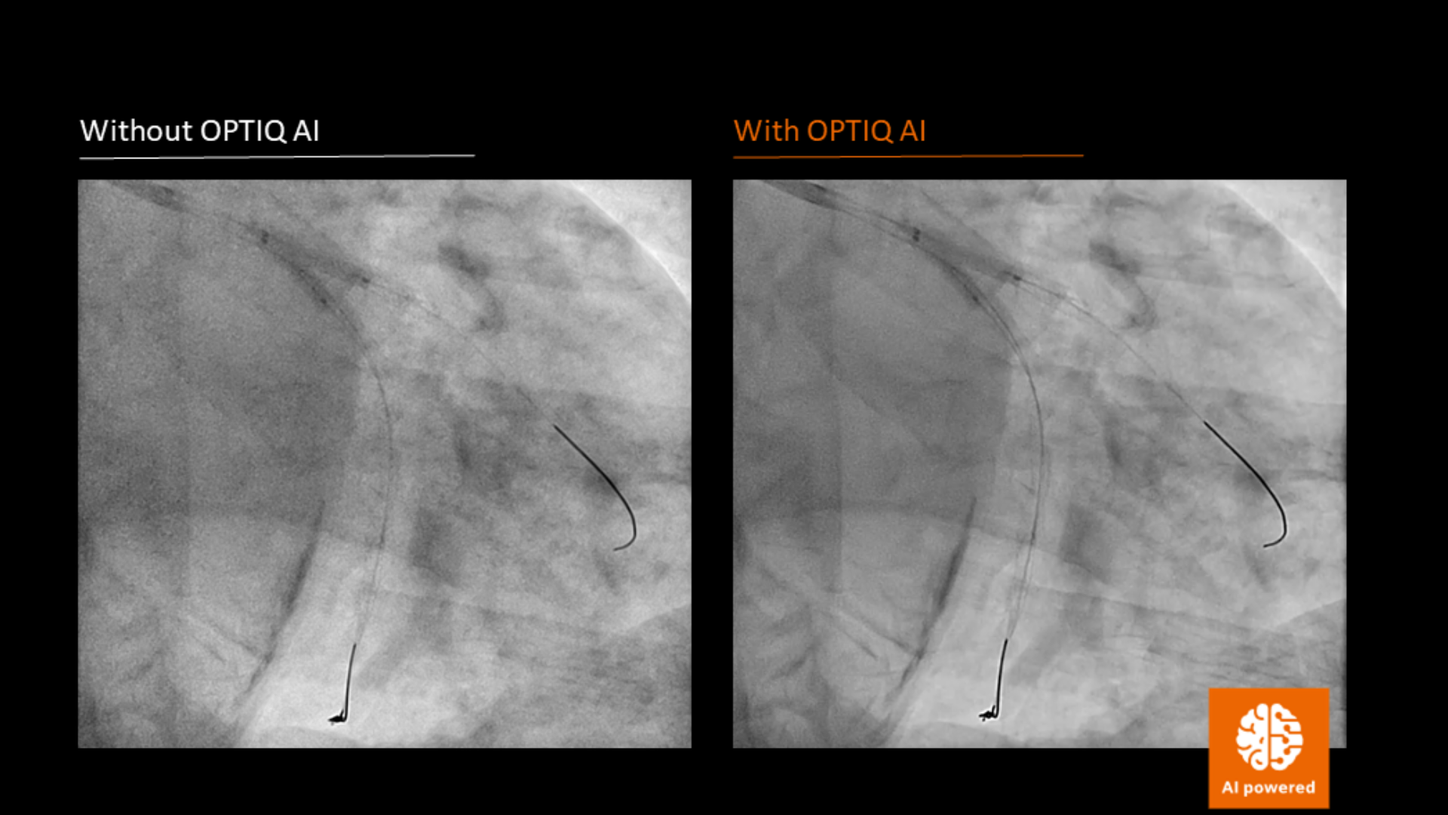 Side-by-side X-ray images comparing standard imaging versus AI-powered OPTIQ technology. Demonstrates improved image clarity, reduced noise, and optimized radiation dose for cardiovascular procedures using advanced AI algorithms.