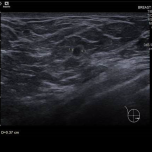 Image E: Ultrasound image showing a similar-appearing mass in the lower inner right breast.