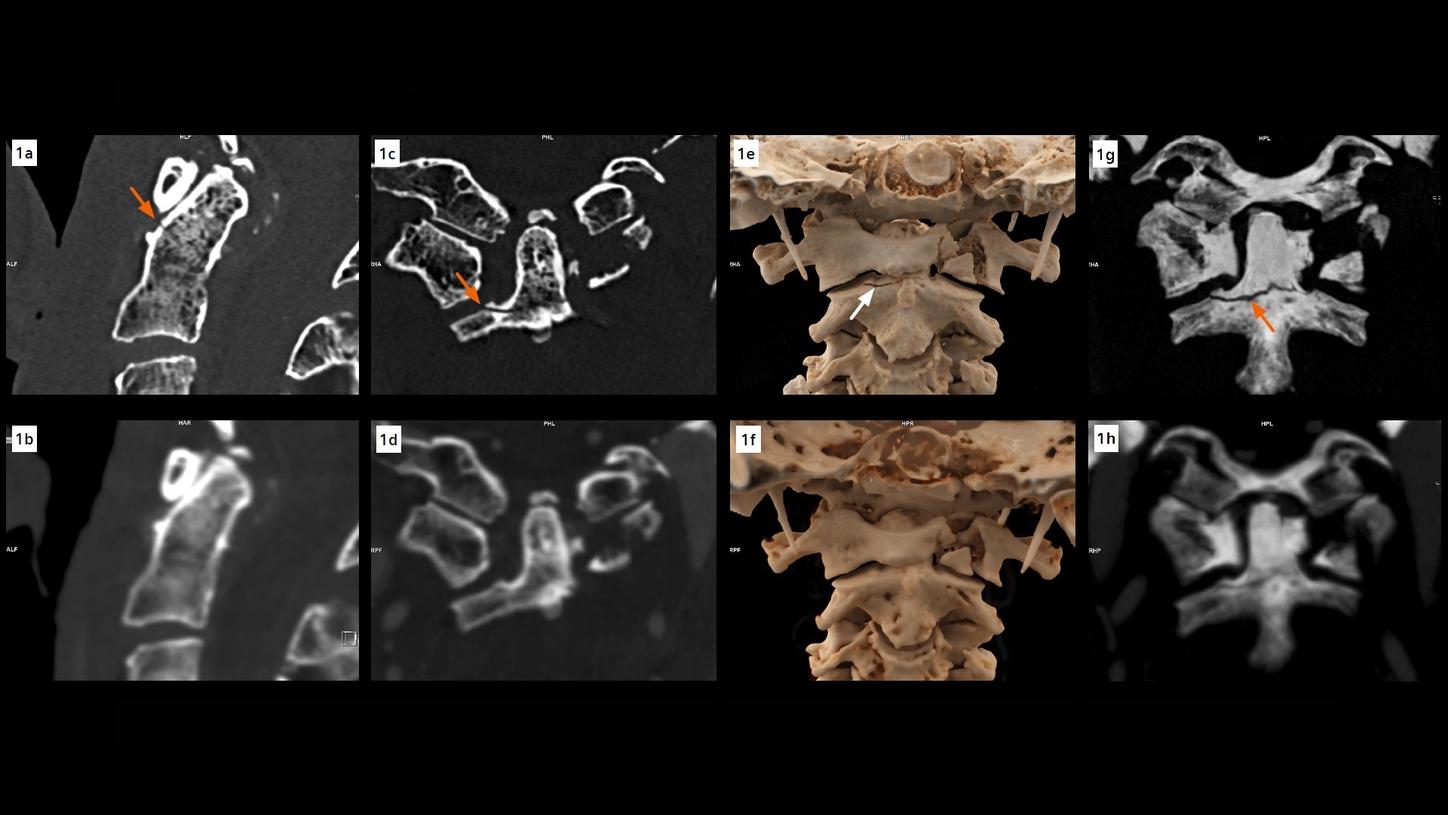 A fracture of the base of the C2 dens, not seen in the EID CT images, is clearly seen in the PCD images. The visibility of the fracture line is improved in the thin slab MIP images
