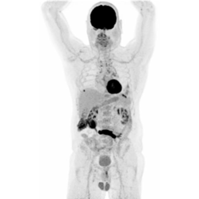 Oncology Indications Colorectal