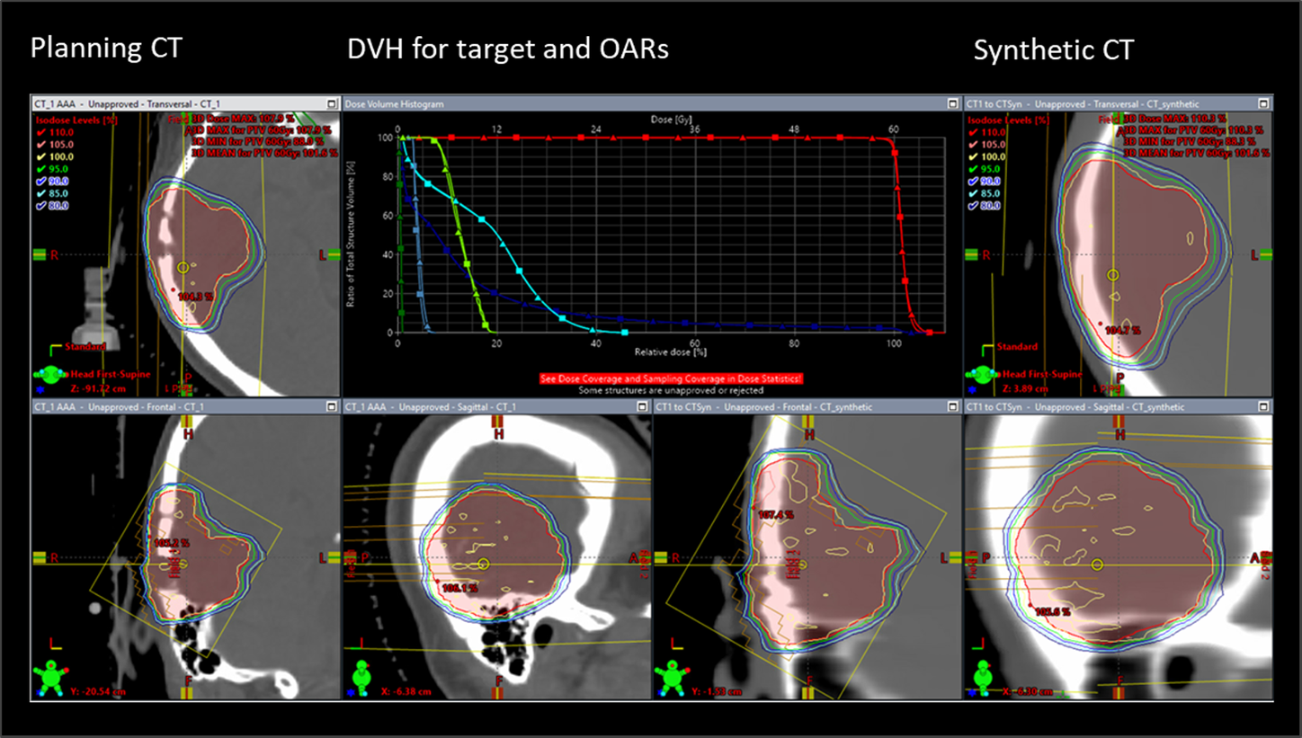 VMAT plan optimization in Eclipse
