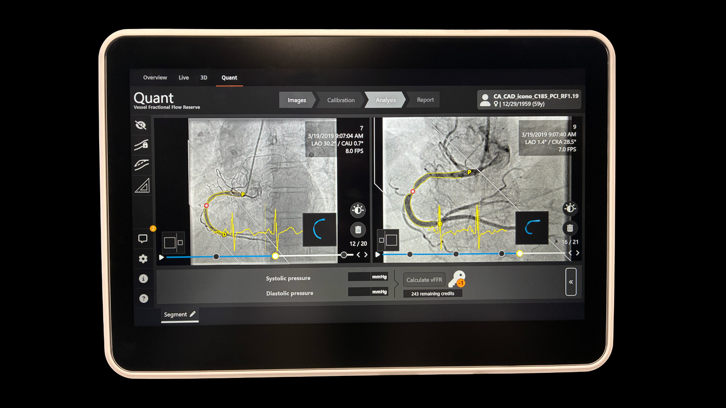 Second angiogram