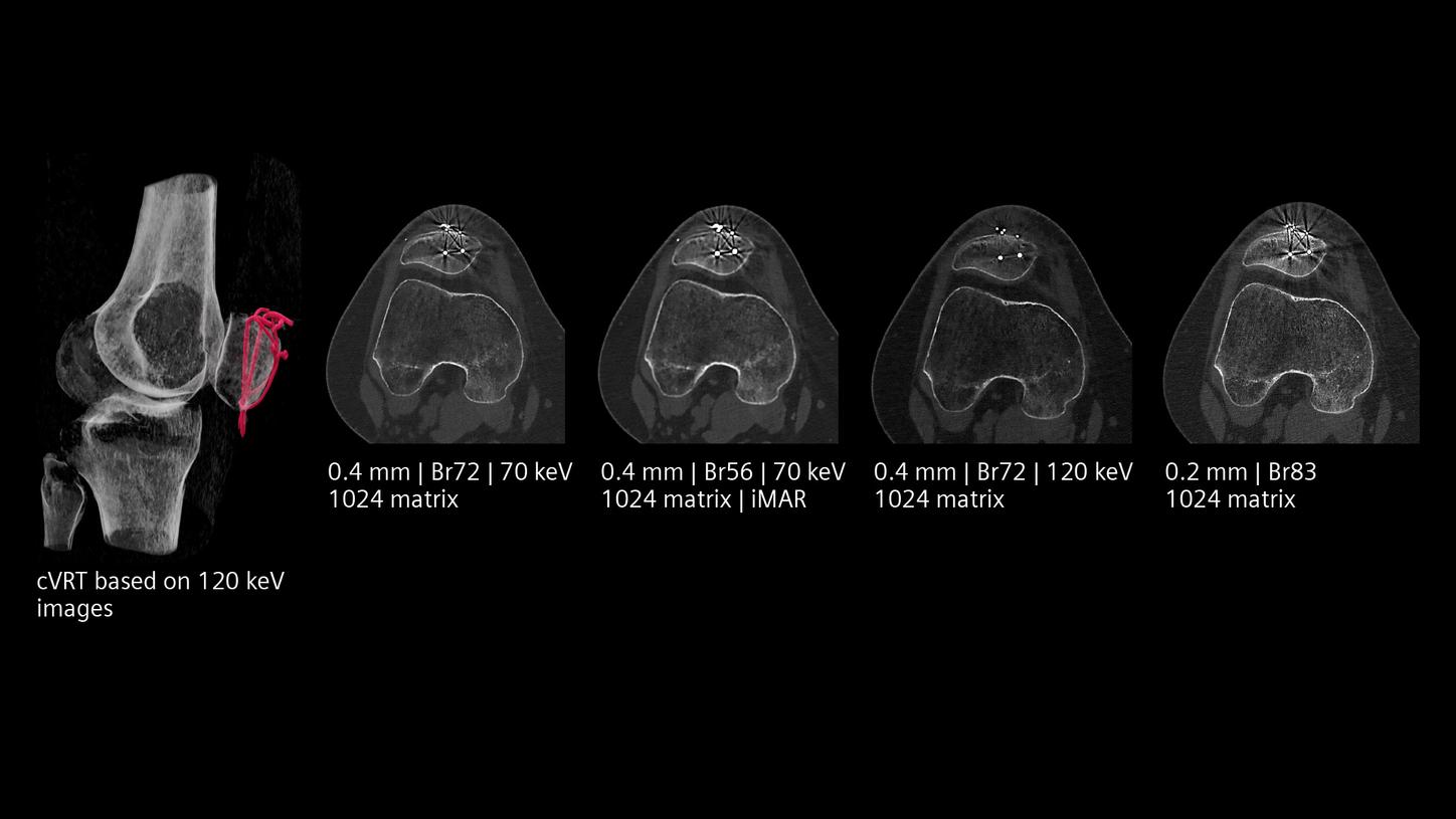 Optimizing image quality and metal artifacts