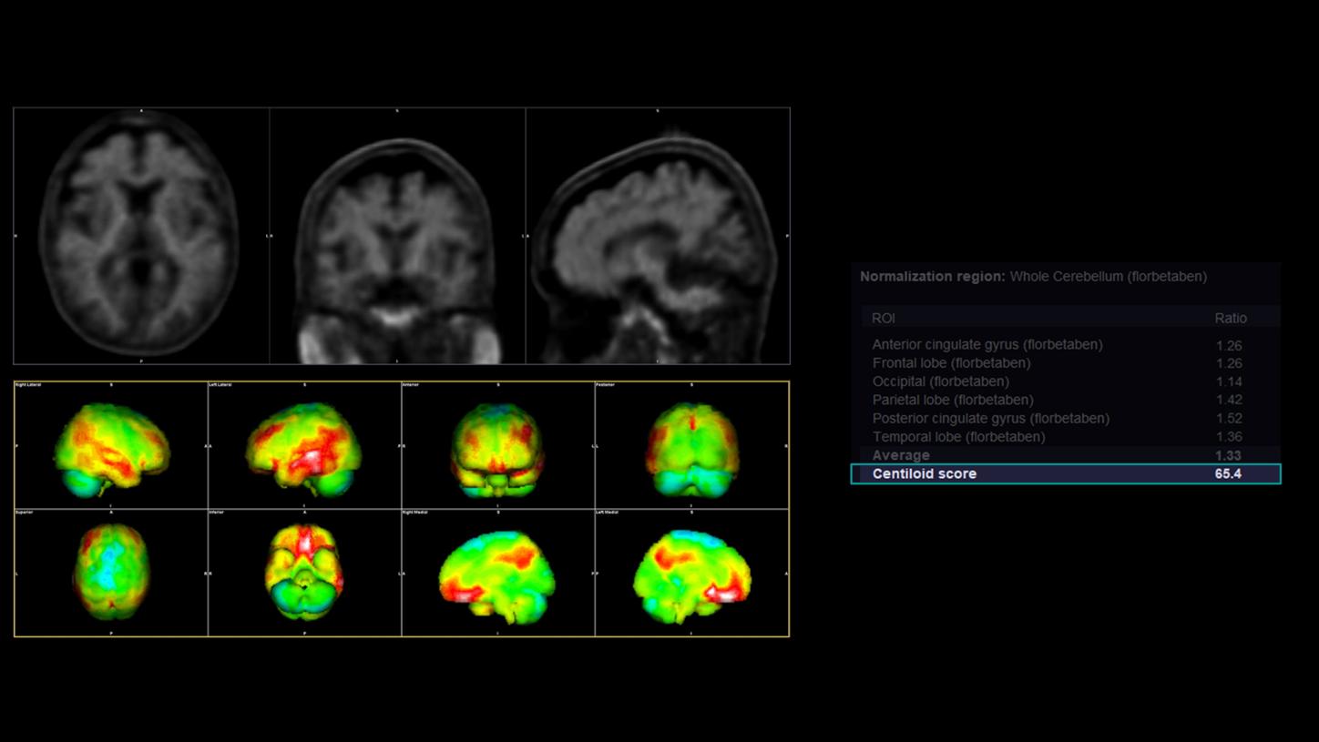 Alzheimers Disease