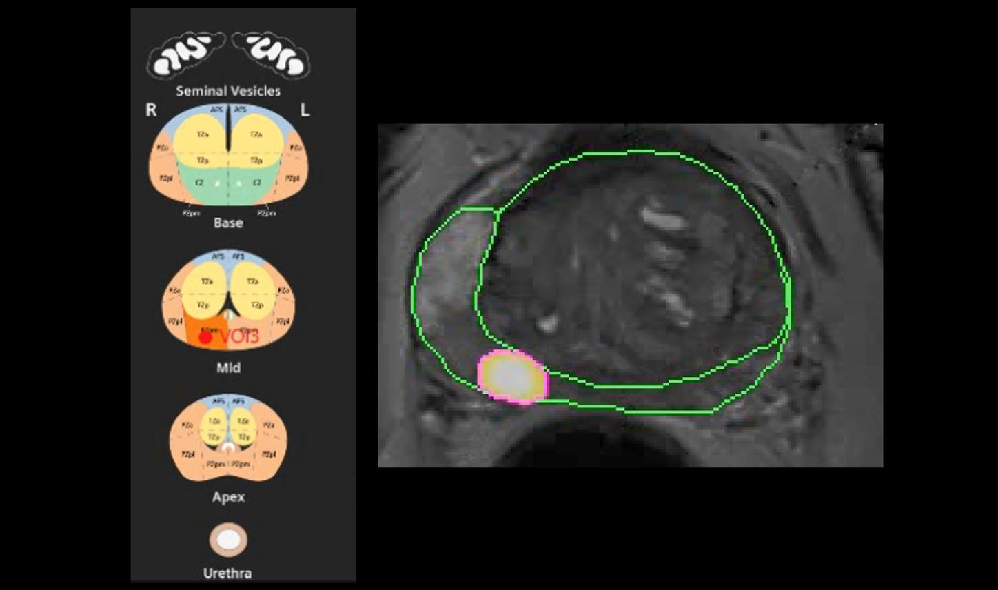 AI-powered prostate reading and reporting