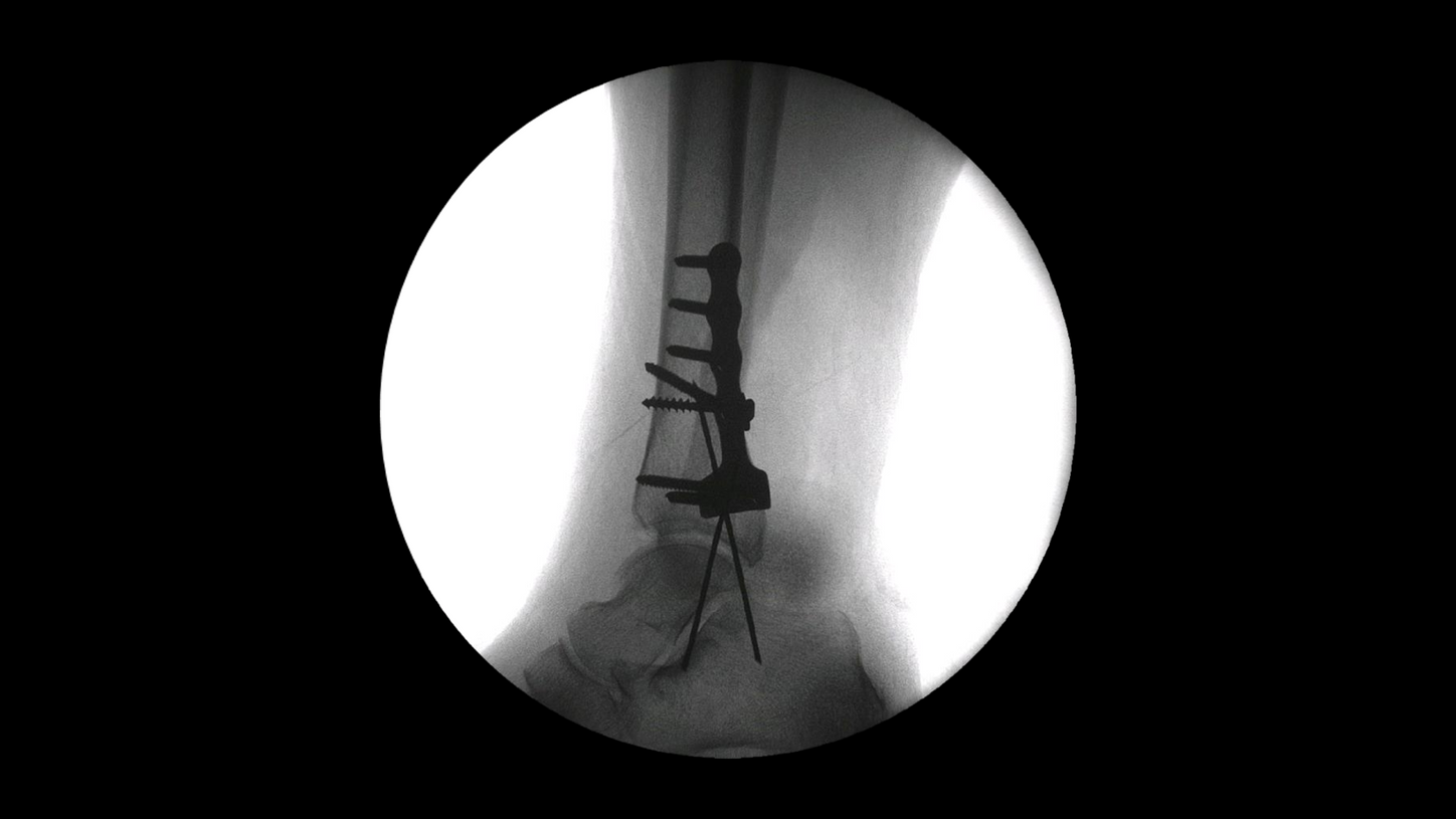 Distal tibia surgery with Cios Fit, a mobile 2D C-arm for surgery.