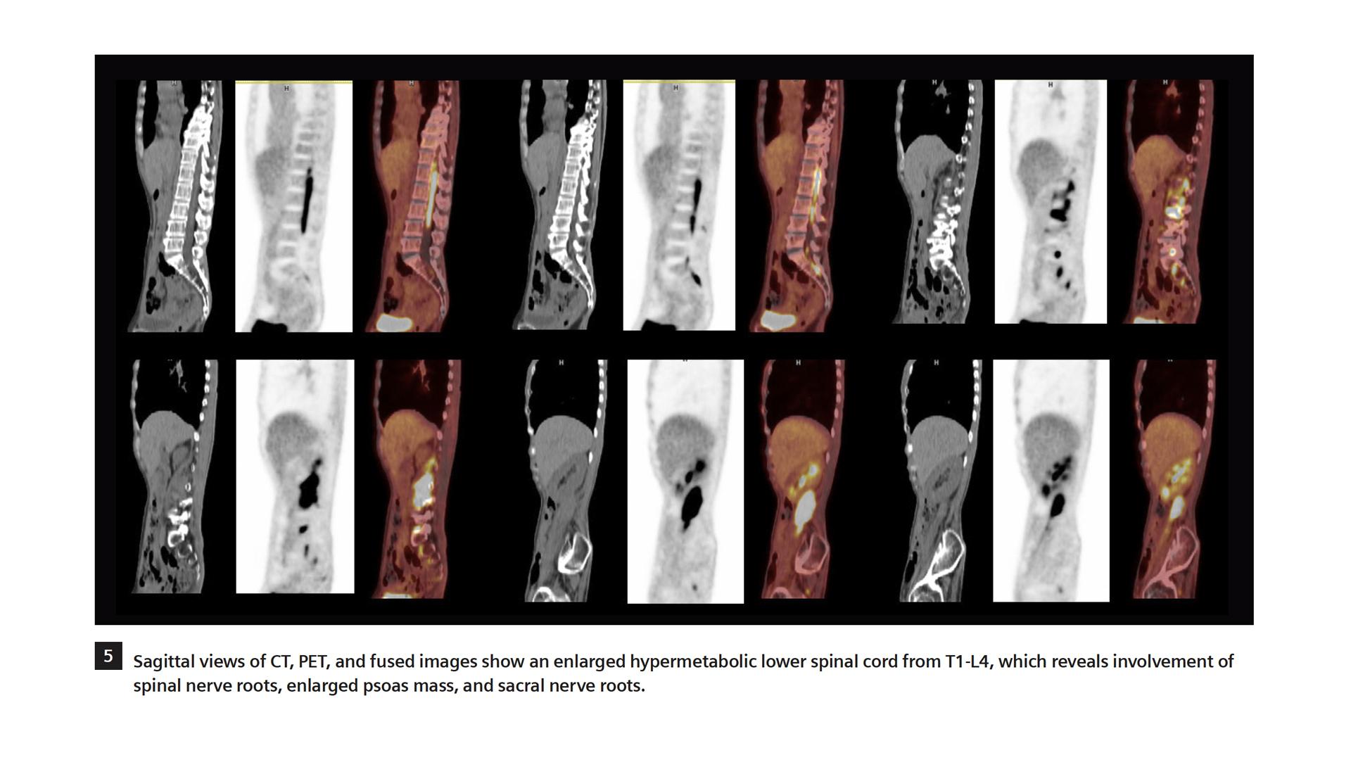 18F FDG PET/CT Delineation of Diffuse Large B-cell Lymphoma - Siemens ...
