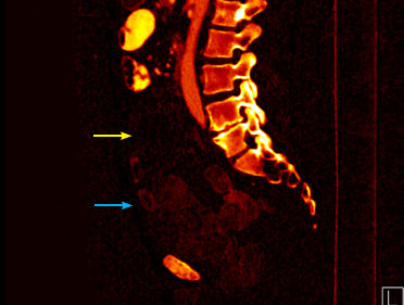 Fig. 10: Comparative sagittal images between iodine mapping image and conventional CT scan image