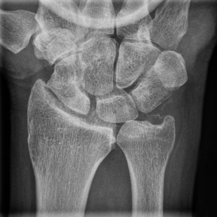 X-ray of a wrist