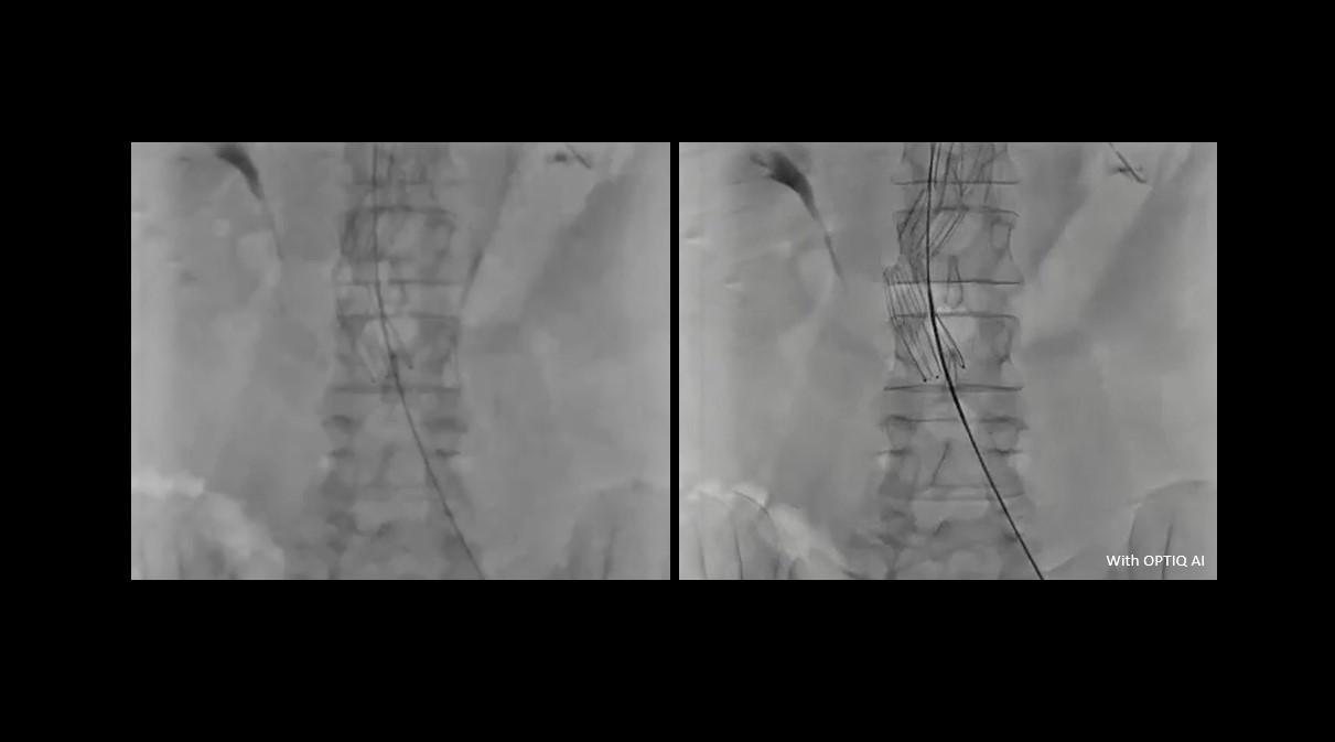 Comparison of clinical imaging with and without OPTIQ AI