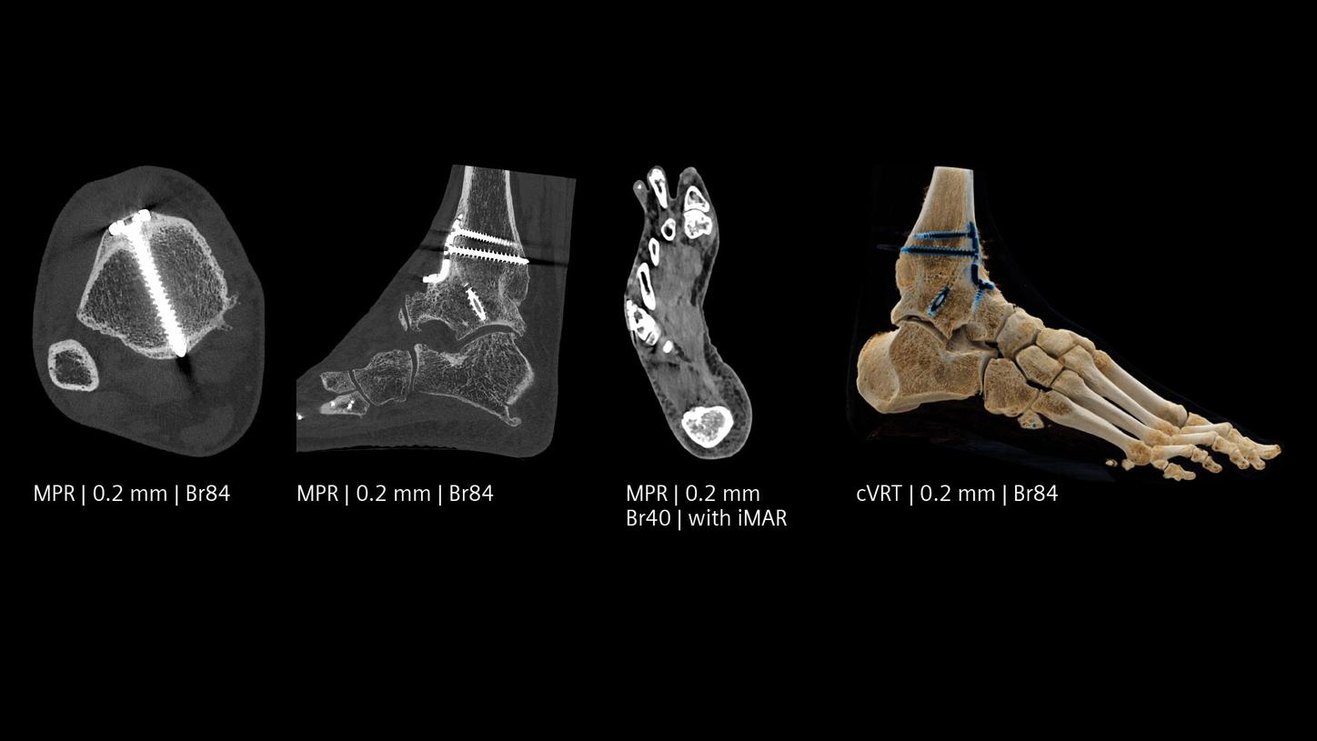Photon-counting CT scan of a foot with metal object with Quantum HD imaging and iMAR, showing metal artifact reduction