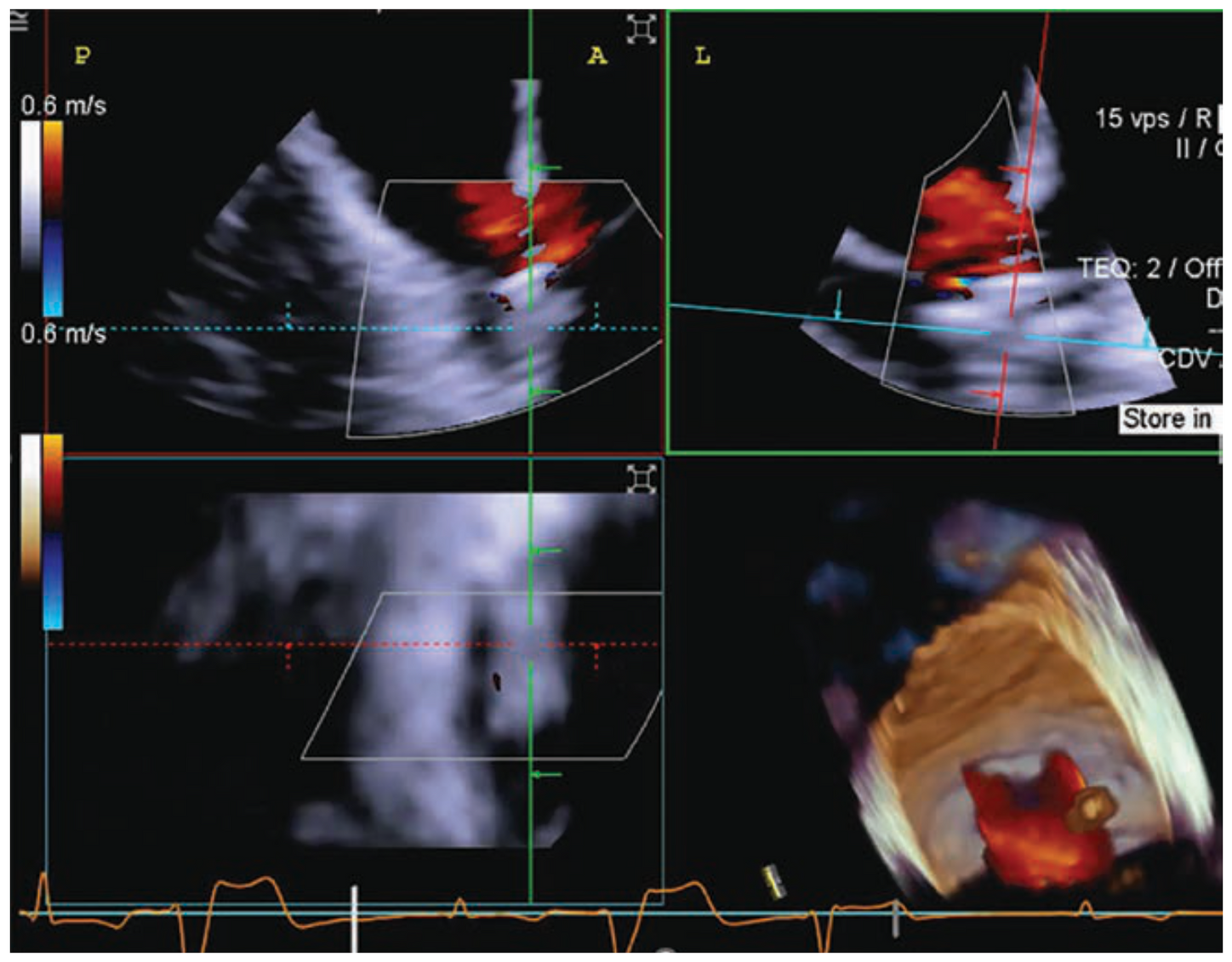 Tricuspid TEER With 4D ICE Guidance