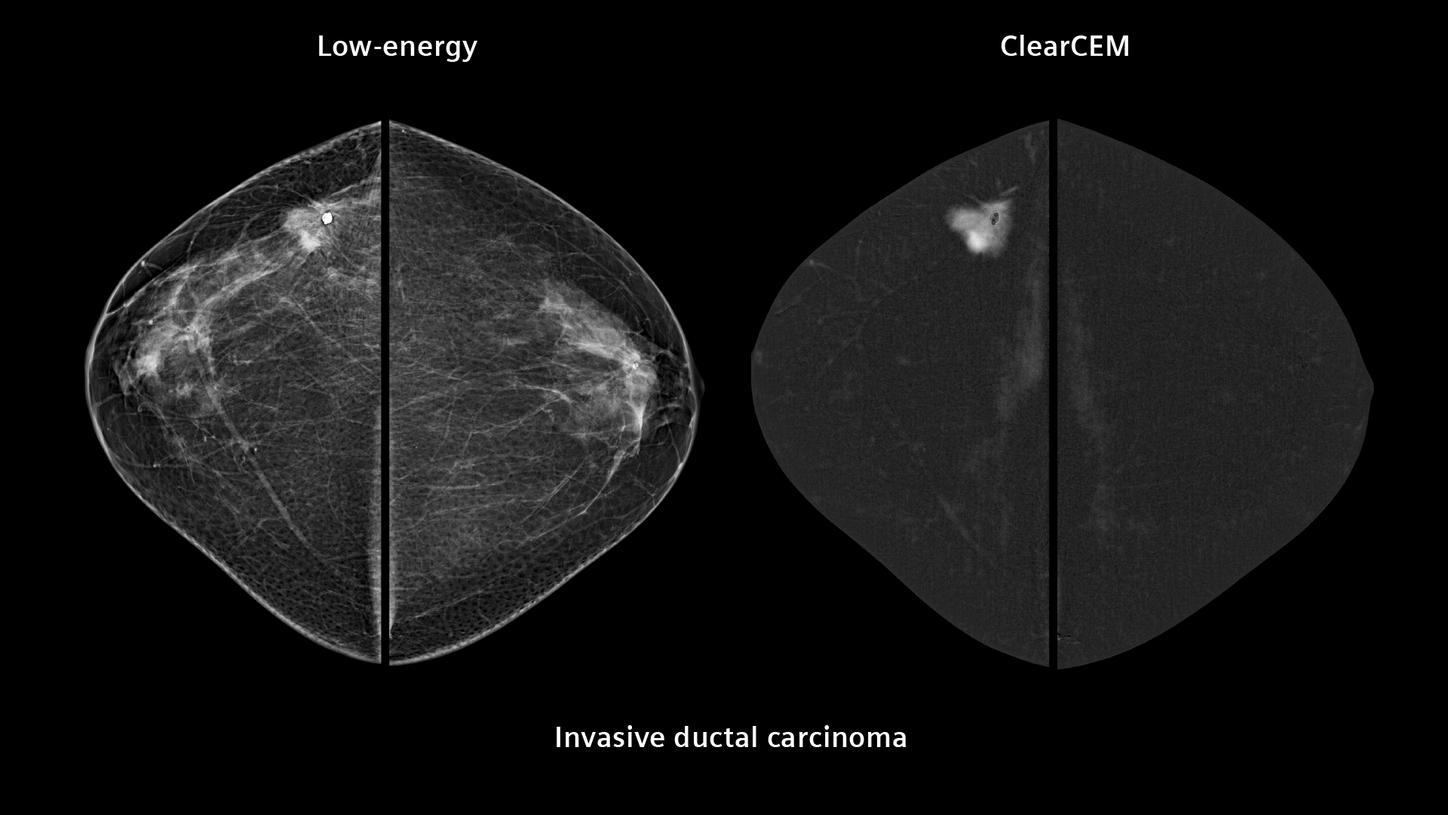 clinical image of comparison between low energy and ClearCEM Lesion detection