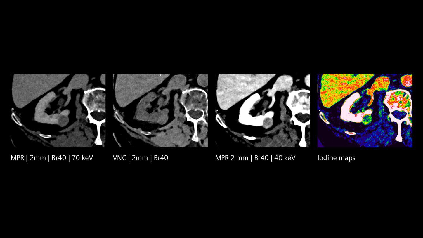 Clinical images, MPR, VNC, iodine maps: inherently available spectral information for incidental lesion evaluation.