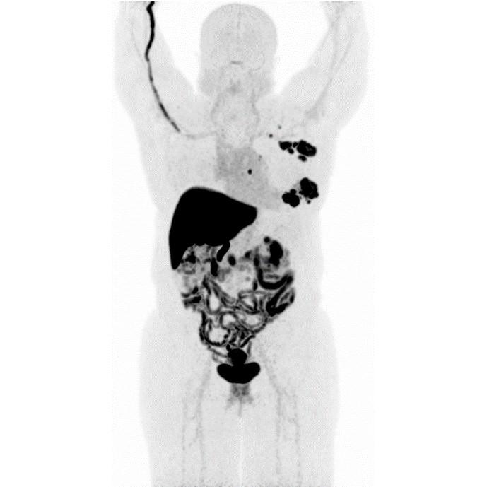 Oncology Indications Cerianna Breast