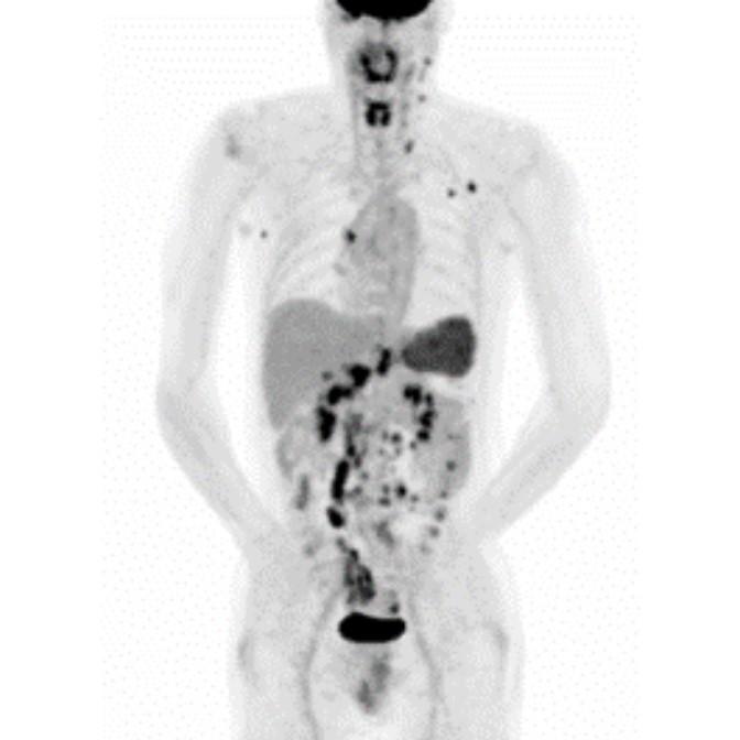 Oncology Indications Lymphoma