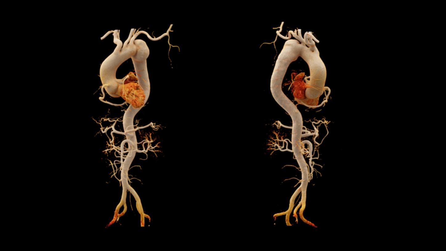 cVRT images demonstrate three dimensional views of the aneurysm, the aorta and the coronary arteries.