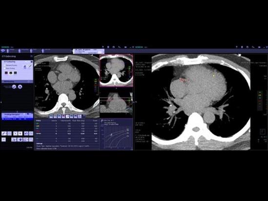 syngo.CT CaScoring