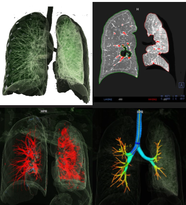 Fig.2: syngo.via Pulmo 3D airway reconstruction demonstrating compression of the left bronchial tree.
