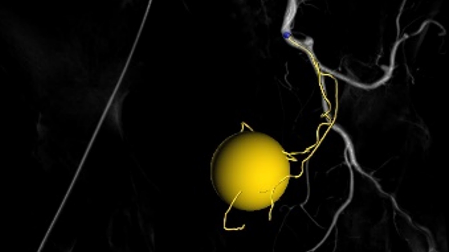 Marking the prostatic gland as a sphere