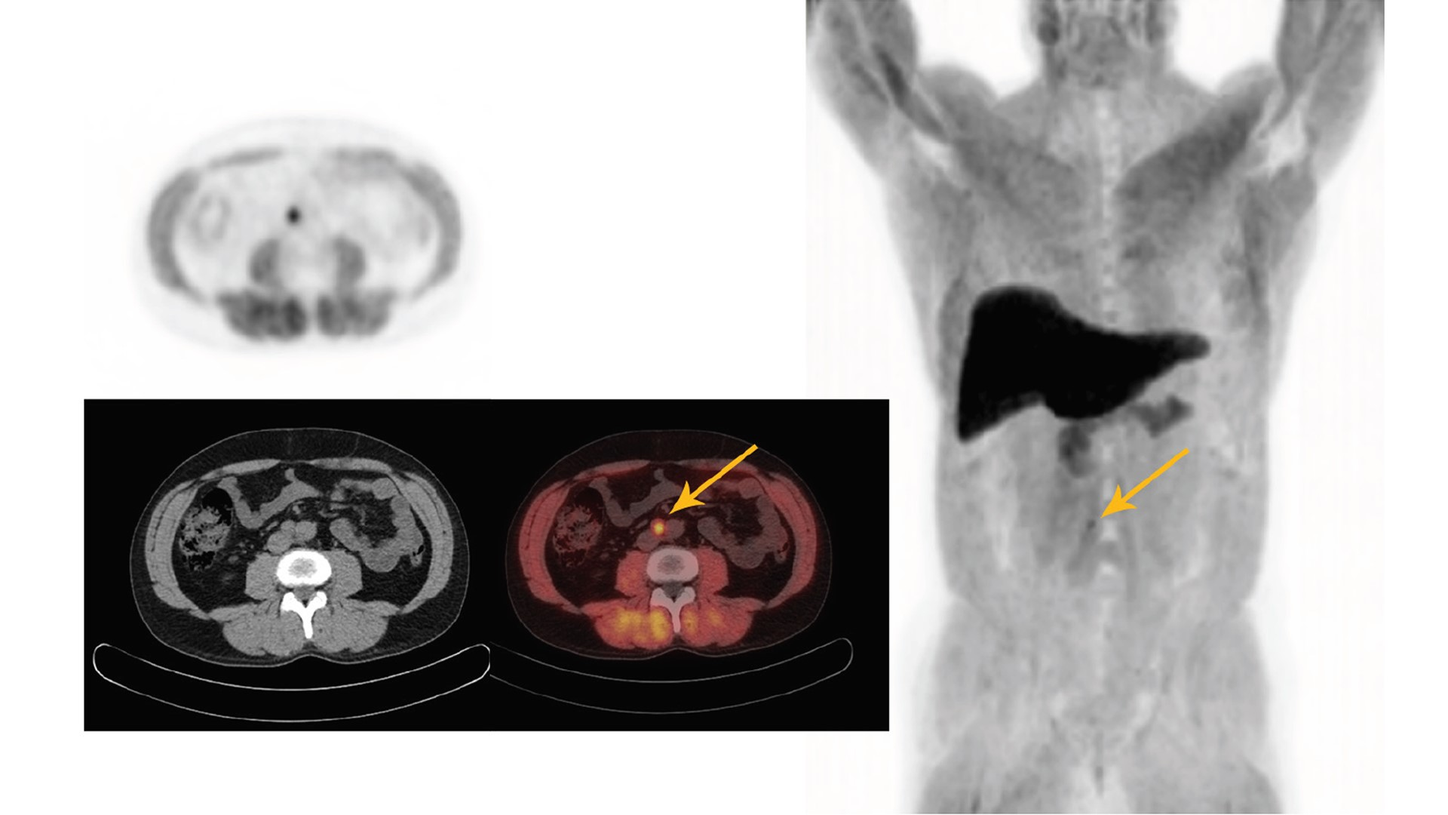 A 68Ga PSMA study, performed on Biograph Vision, aides in the visualization of bladder invasion and pelvic lymph node metastases.