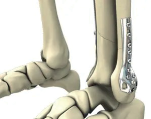 Ankle MRI