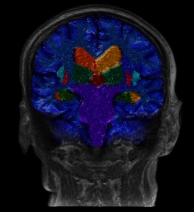  Source: Wentworth-Douglas Hospital, Dover, New Hampshire, USA.    Segmentation of key brain structures on MRI in an elderly patient presenting with symptoms of Alzheimer’s disease.  Source: Lausanne University Hospital, Switzerland. 
