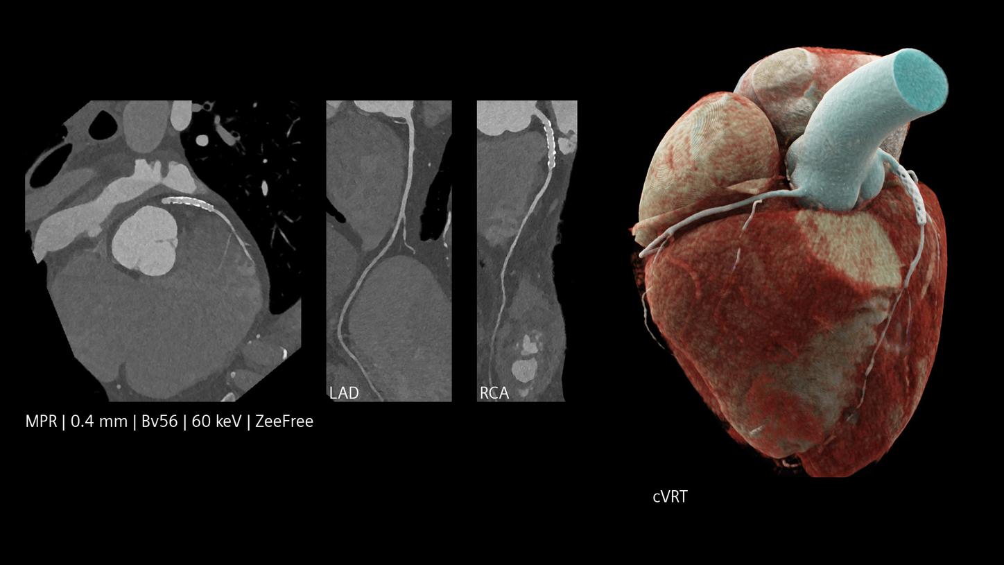 Cardiac CT showing stents in coronary arteries and a 3D heart model with scan and dose parameters listed.
