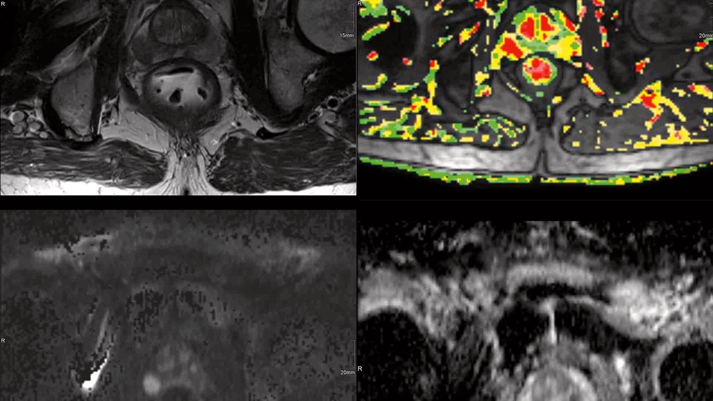 MR – Prostate Workshop